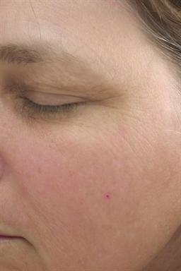 Left side of face after treatment