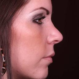 Right view of nose after rhinoplasty