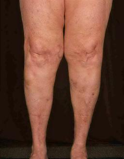 Front of legs after treatment