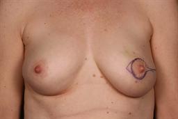 Front of breasts before surgery