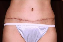 Front of abdomen after surgery