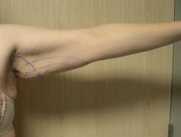 Front left arm before surgery