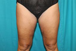 Front view of thighs after CoolSculpting