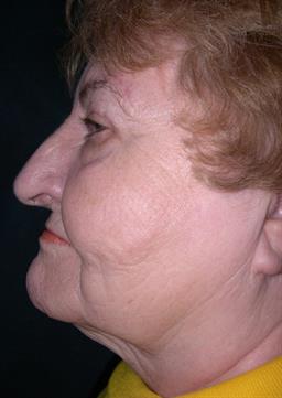 Left side view of neck before neck lift