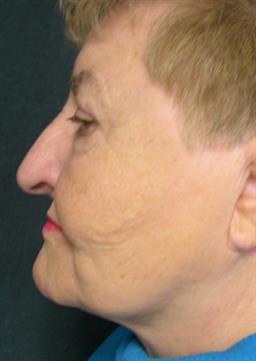 Left side view of neck after neck lift