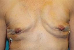 After mastectomy