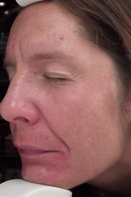 Left view of face after skin care products
