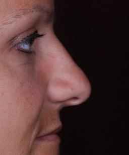 Right view of nose before rhinoplasty