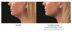 CoolSculpting beore & after