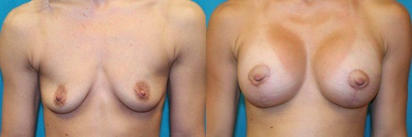 This patient had a bilateral breast augmentation with a circumvertical mastopexy.