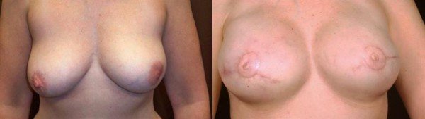 Breast Reconstruction before & after