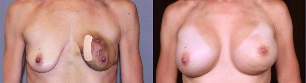 Breast reconstruction beore & after