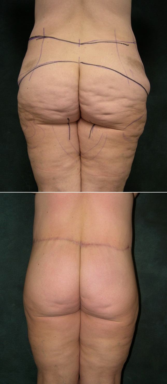 Lower Back Lift Surgery, London & UK