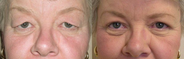 Blepharoplasty before & after