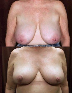 Breast Reduction before & after