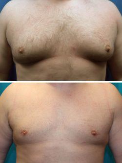 Gynecomastia before & after