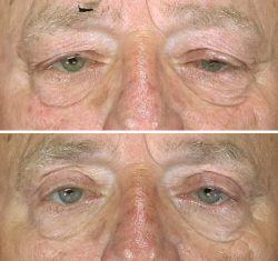 Blepharoplasty before & after