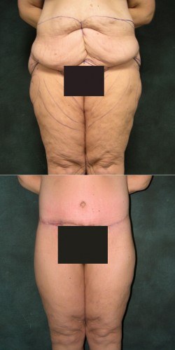 The Circumferential Body Lift Procedure For the Surgery Patient