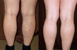 Legs Before & After