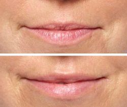 Dermal fillers before & after