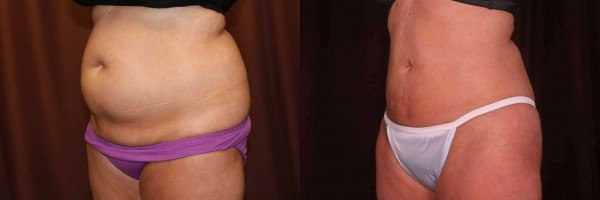 Fox Valley Plastic Surgery  Body Lift Surgery (Lipectomy)