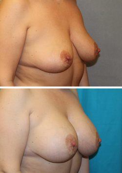 Breast augmentation before & after