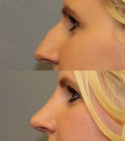 Rhinoplasty Before & After