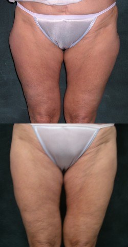 Thighs Lipo before & after