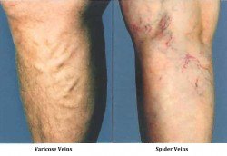 Varicose veins and spider veins