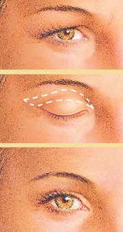 Eyelid surgery incision graphic