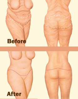 Fox Valley Plastic Surgery  Body Lift Surgery (Lipectomy)