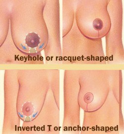 breast reduction