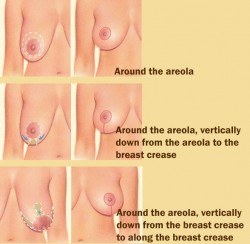 breast reduction graphic