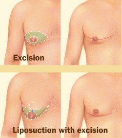 gynecomastia incision