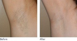 Laser Hair Removal before & after