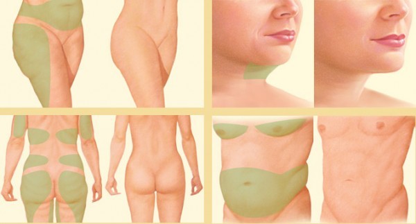 liposuction locations