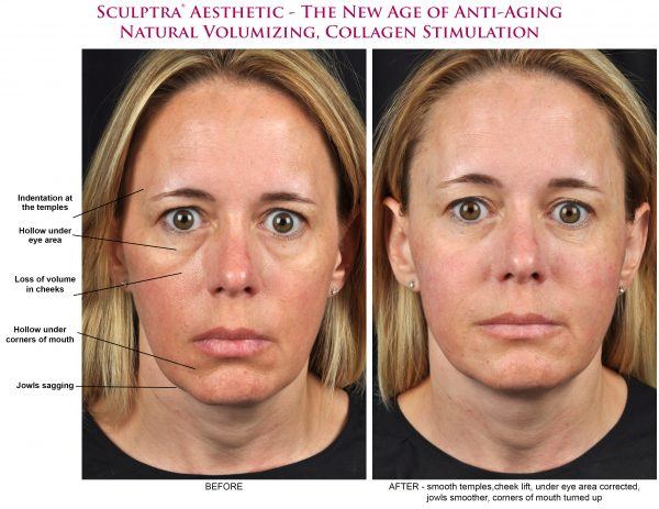 Sculptra before & after