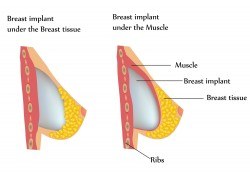 Breast implants