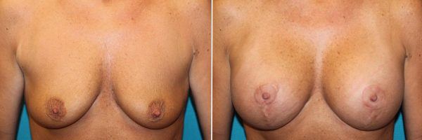 Breast lift before & after