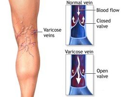 varicose veins