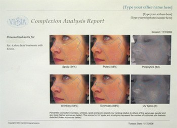 VISIA® Complexion Analysis Report