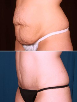 Moderate Tummy Tuck Before & After