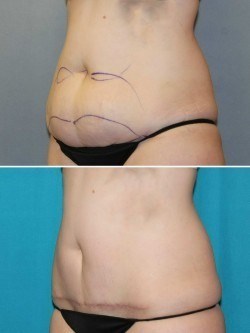 Fox Valley Plastic Surgery Mini Tummy Tuck Surgery