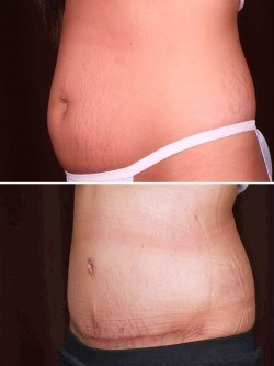 Oblique Left before & after