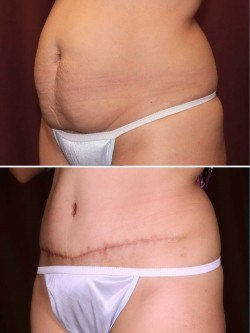 Tummy Tuck before & after