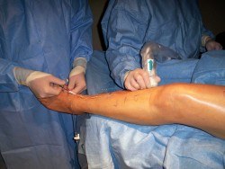 Vein Procedure