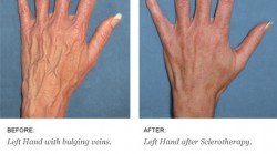 Hand Sclerotherapy before & after