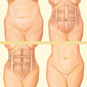Tummy Tuck procedure graphic