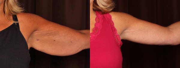 Arm Lift Before & After