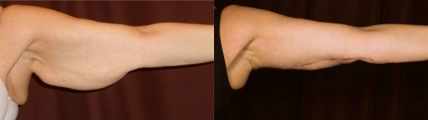 Arm Lift Before & After